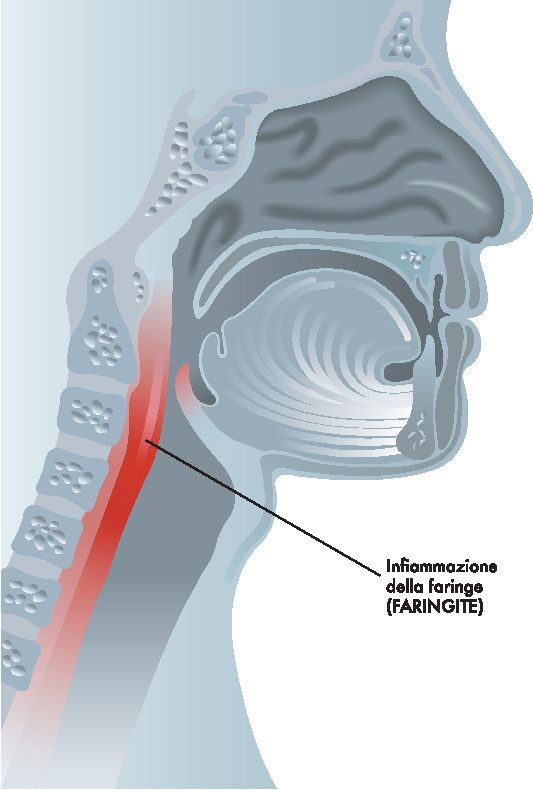 Come curare la faringite