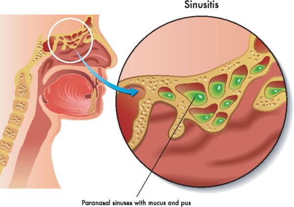 Come curare la sinusite