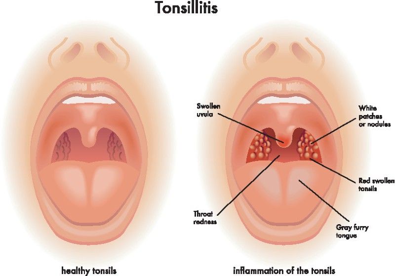 Come curare la tonsillite